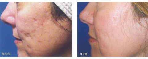 Před a po aplikaci laserového přístroje na kůži s jizvami