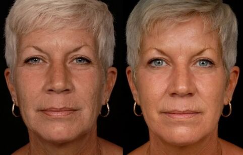 Výsledek laserového ošetření pokožky obličeje - redukce vrásek